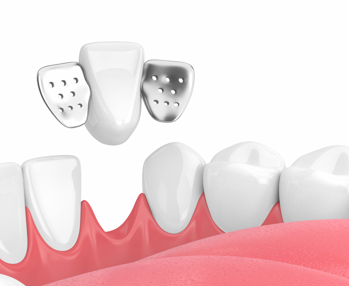 Trồng cầu răng sứ là gì? Các loại cầu răng sứ phổ biến