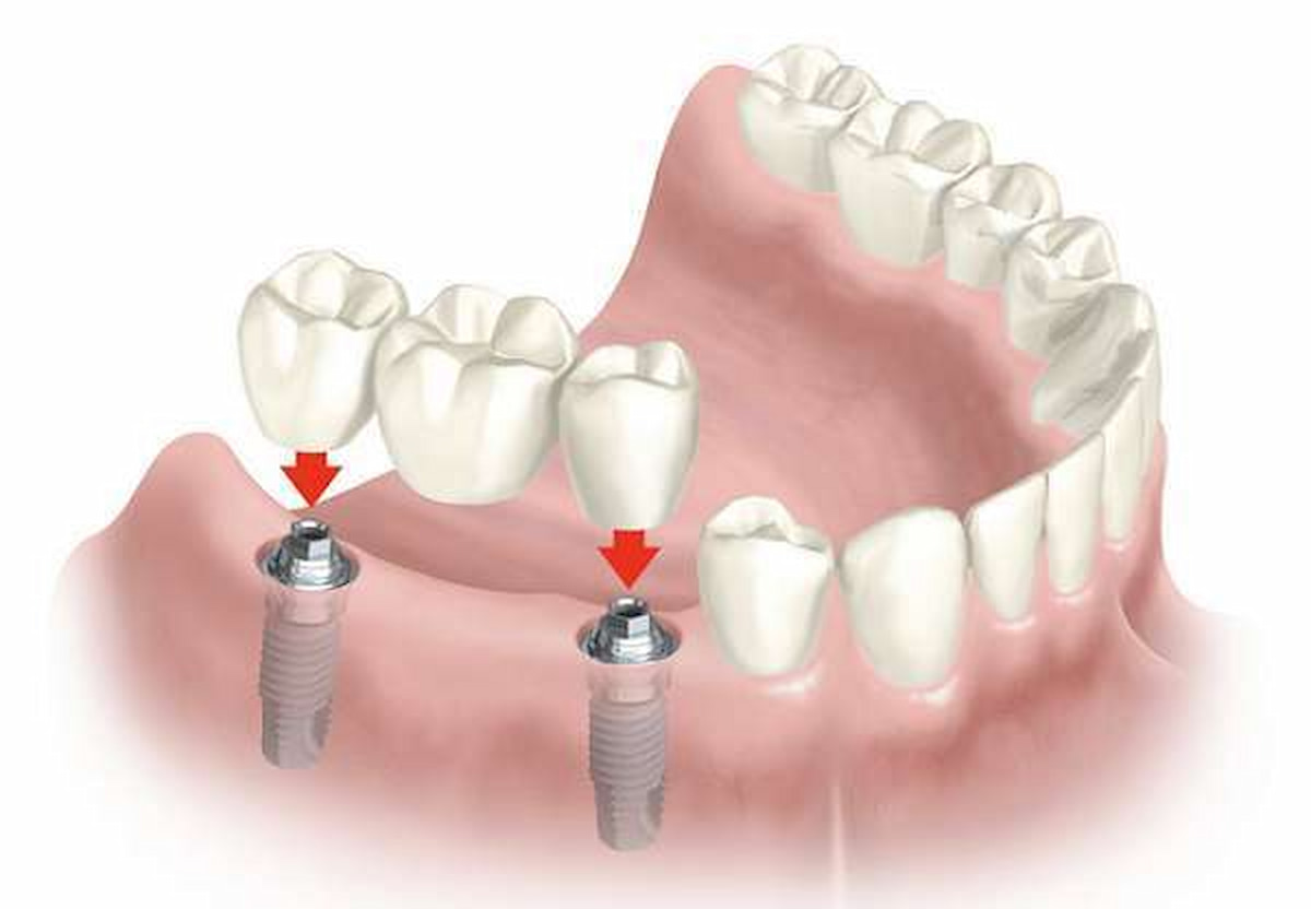 Nên làm cầu răng sứ hay cấy ghép Implant khi mất răng?