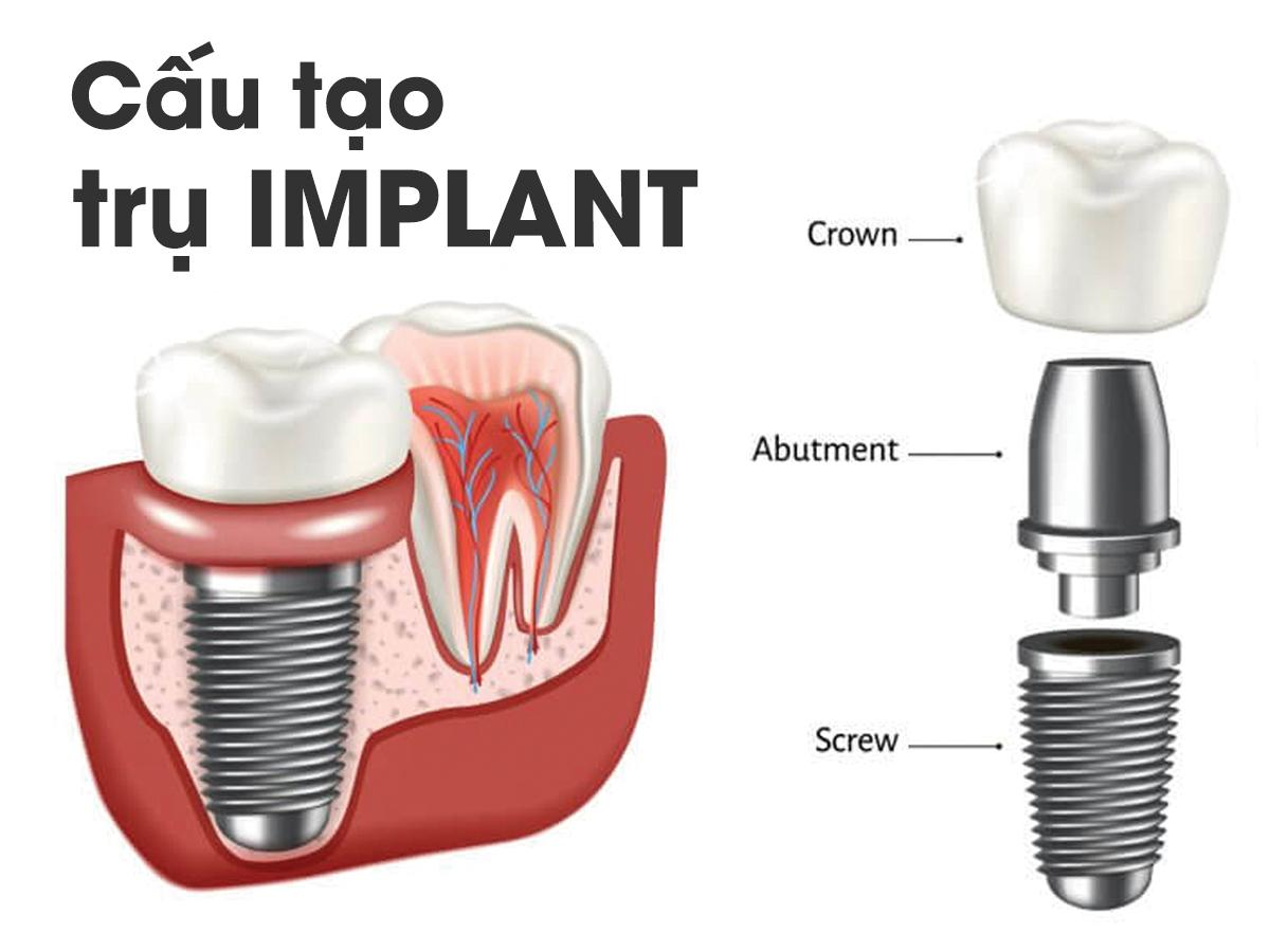 Cấu tạo một răng sứ Implant gồm 3 thành phần: trụ Implant, Abutment, mão răng sứ được xếp chồng lên nhau