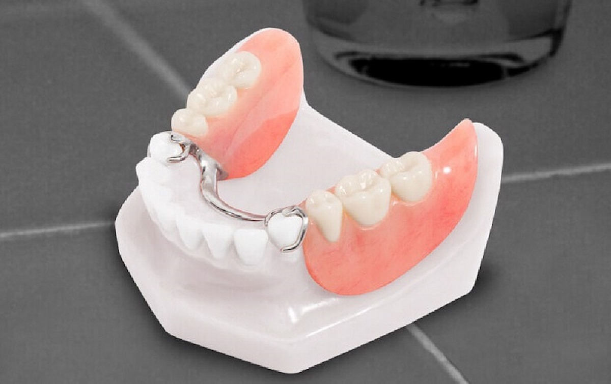 Những giải pháp trồng răng cửa ngoài cấy ghép răng implant là gì?