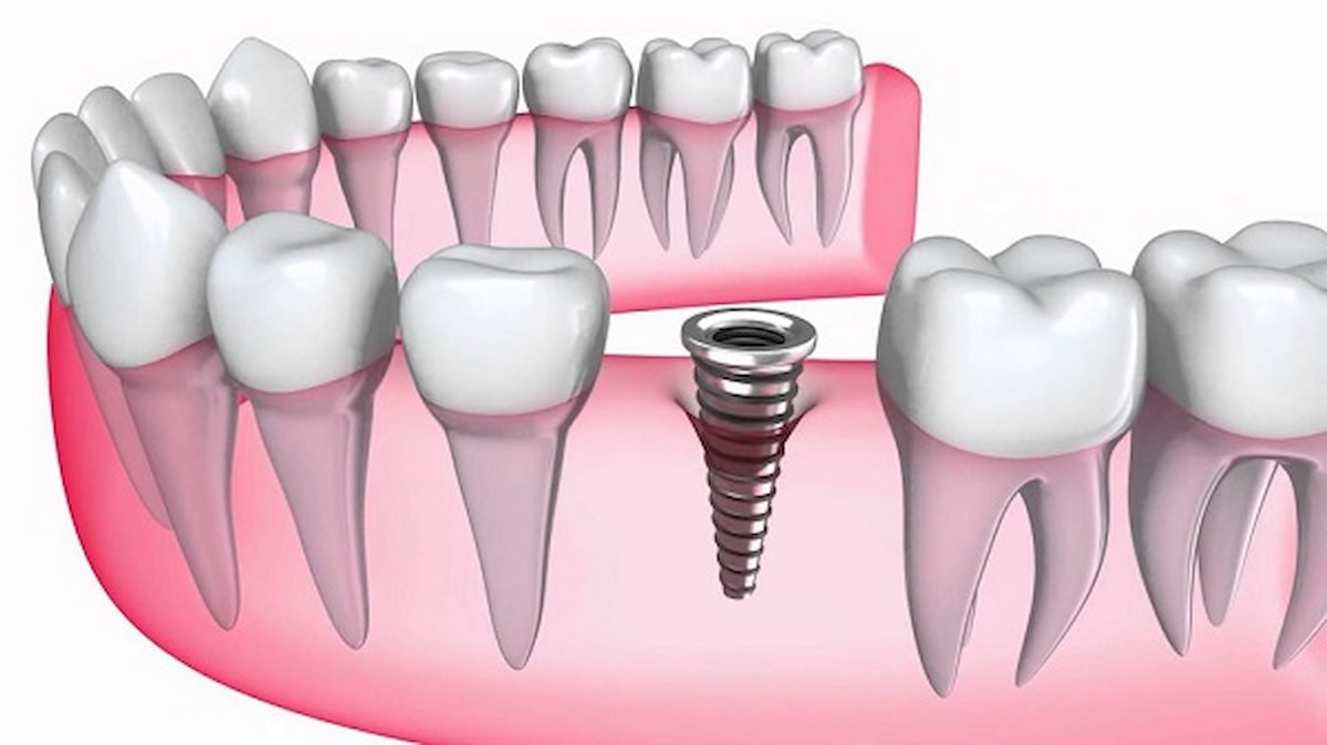 Trồng răng implant có bị hôi miệng không? Cách khắc phục