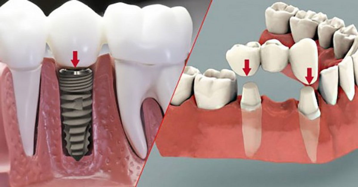 Trồng răng sứ cố định có đau không? Cách giảm đau như thế nào?