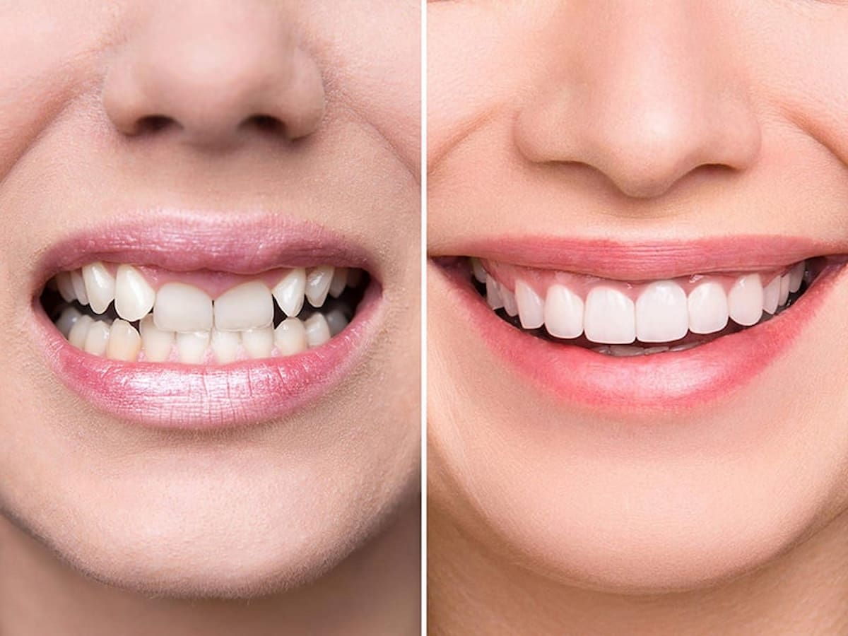 Bọc răng sứ có bị mòn không? Cách khắc phục?