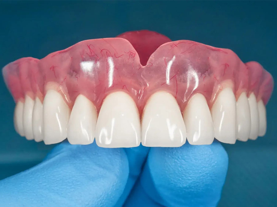 Một hàm răng giả bằng sứ có thể tháo lắp