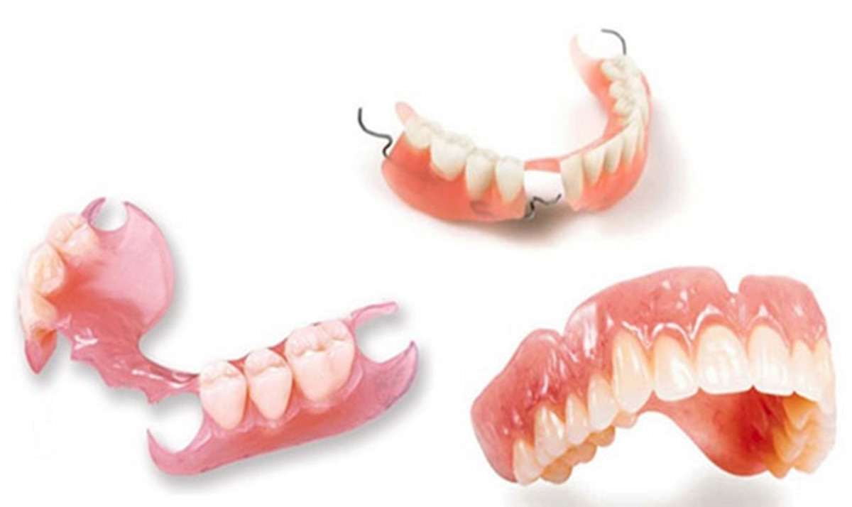 Removable dental implants, removable dental restorations or removable dentures.