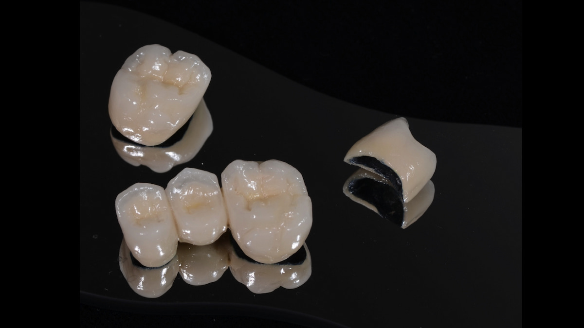Bọc răng sứ titan có bị đen không? Cách khắc phục như thế nào?
