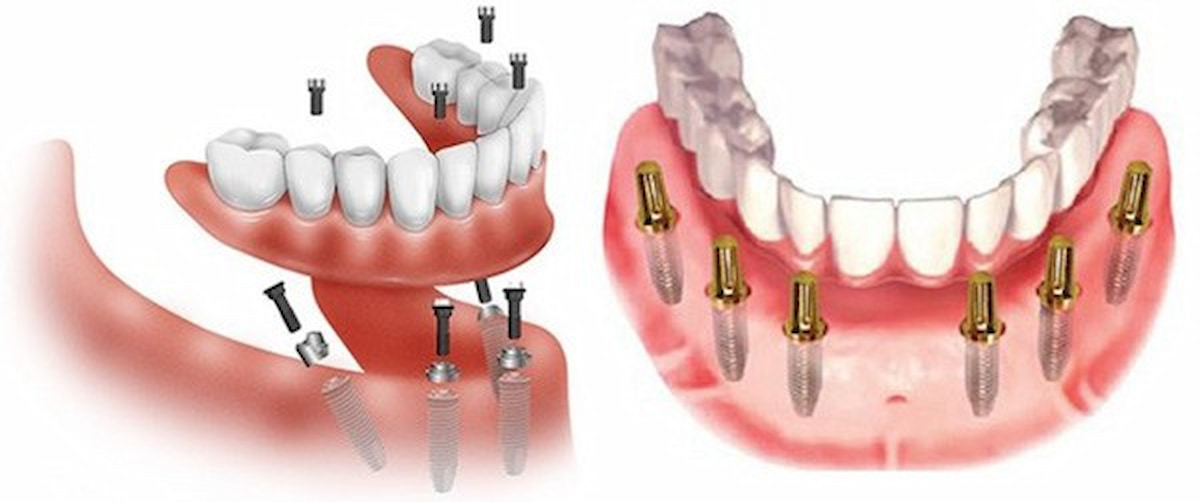 Trồng răng toàn hàm implant có biến chứng không?