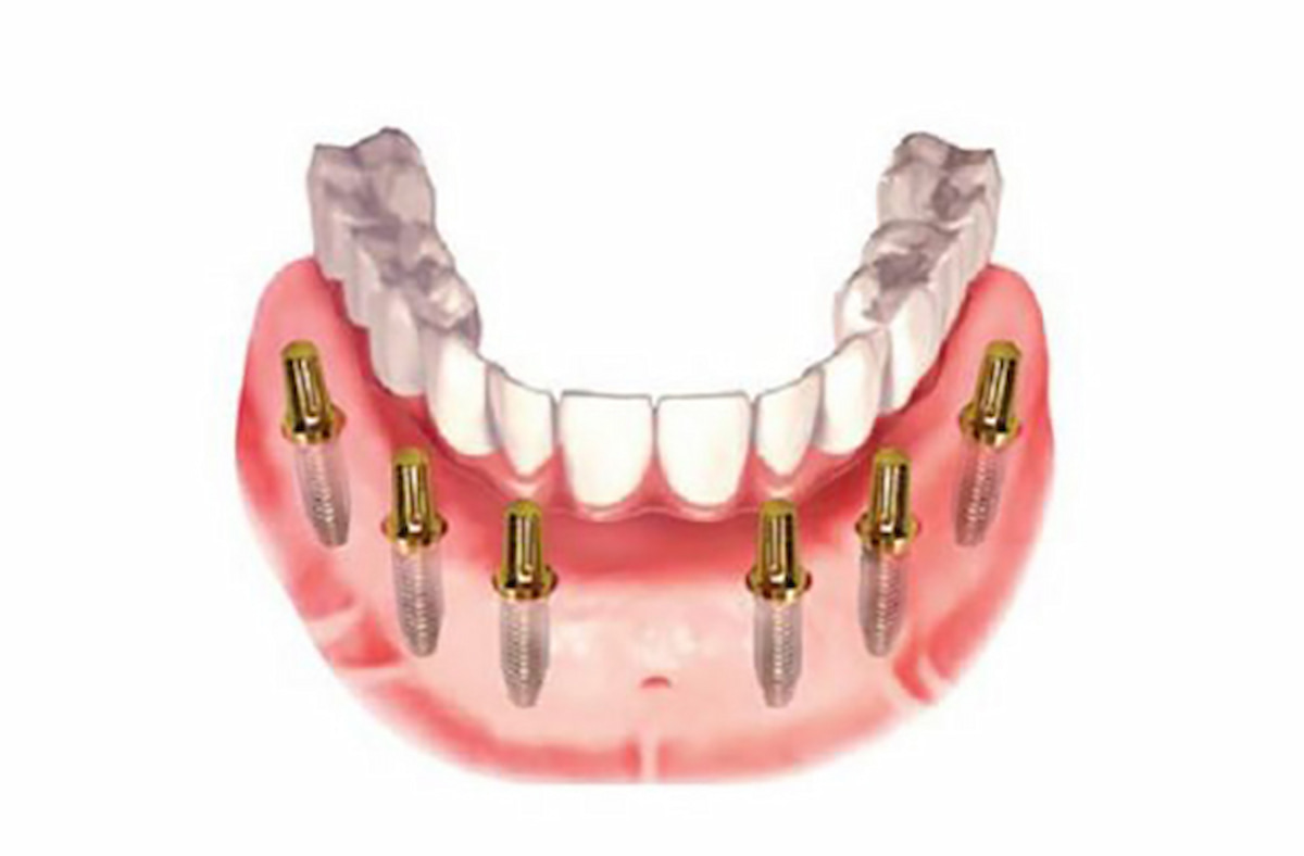 Trồng răng toàn hàm implant có biến chứng không?