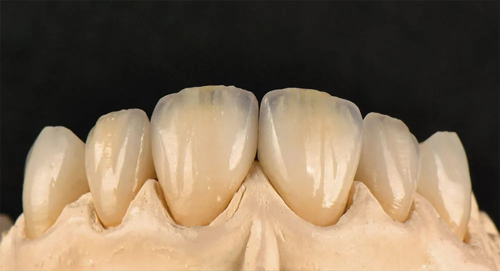 Trồng răng toàn sứ là việc phục hình bằng răng hoàn toàn được làm bằng sứ, không chứa kim loại
