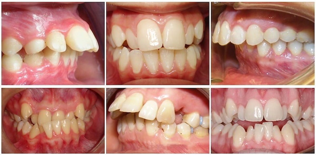 Single-jaw braces are completely possible, but it depends on each person's situation