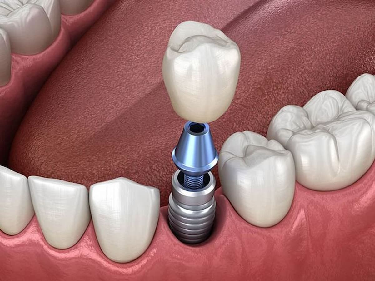 Trồng răng Implant giúp phục hồi chức năng ăn nhai và thẩm mỹ cũng được một cách hiệu quả