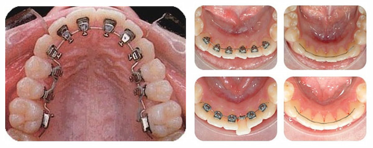 Niềng răng hàm dưới bằng phương pháp nào hiệu quả nhất?