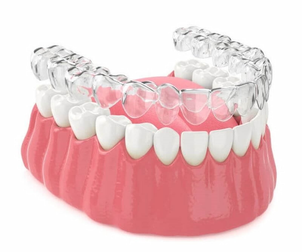 Những phương pháp niềng răng hàm dưới hiệu quả