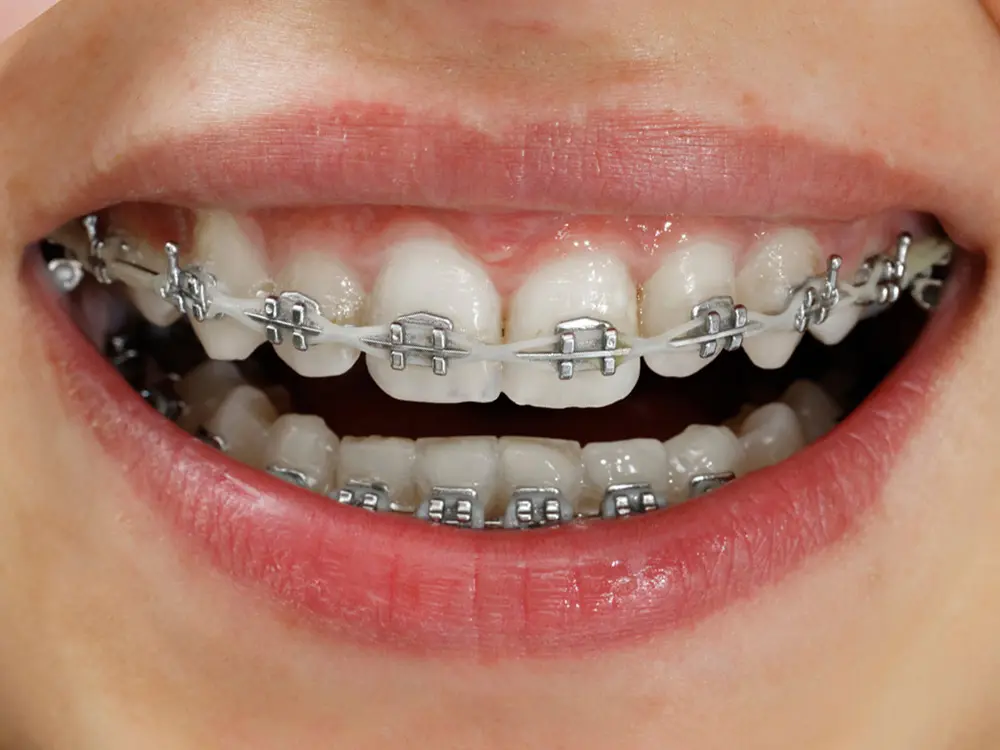 Niềng răng hôm hàm nhẹ bằng mắc cài kim loại có độ thẩm mỹ không cao