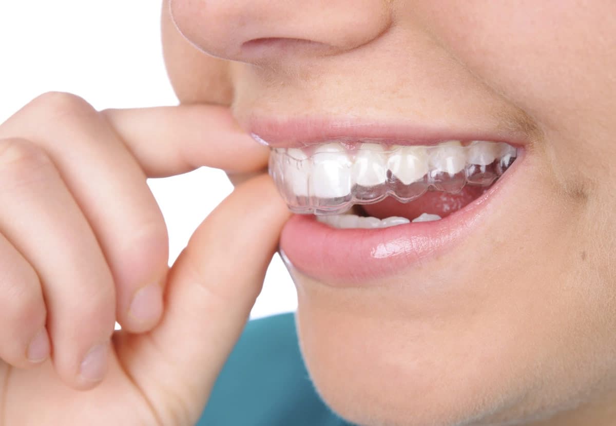 Niềng răng hô hàm nhẹ giá bao nhiêu? Niềng ở đâu uy tín?