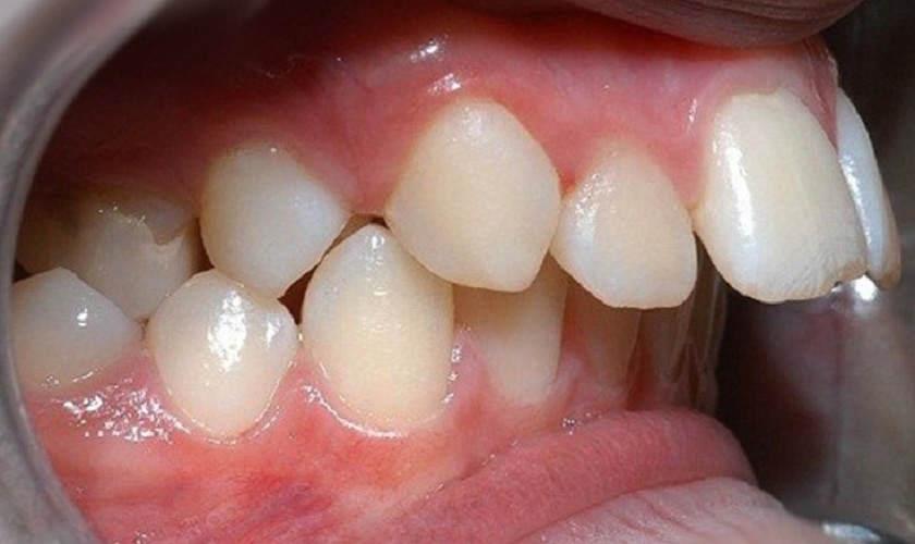 Răng hô là tình trạng răng sai lệch khớp cắn, tương quan hàm trên hô nhiều hơn so với hàm răng dưới
