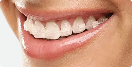 Niềng răng mắc cài sứ dây trong là gì? Ưu điểm và hạn chế