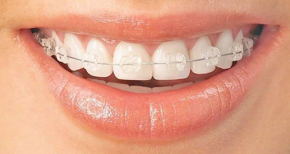Clear wire ceramic braces are highly aesthetic