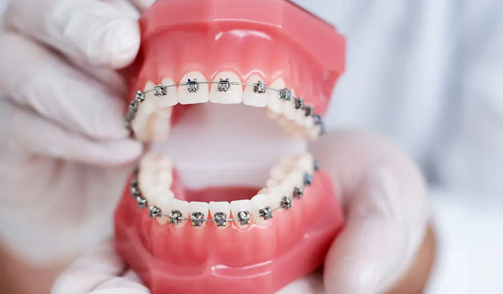 Braces are an effective orthodontic method