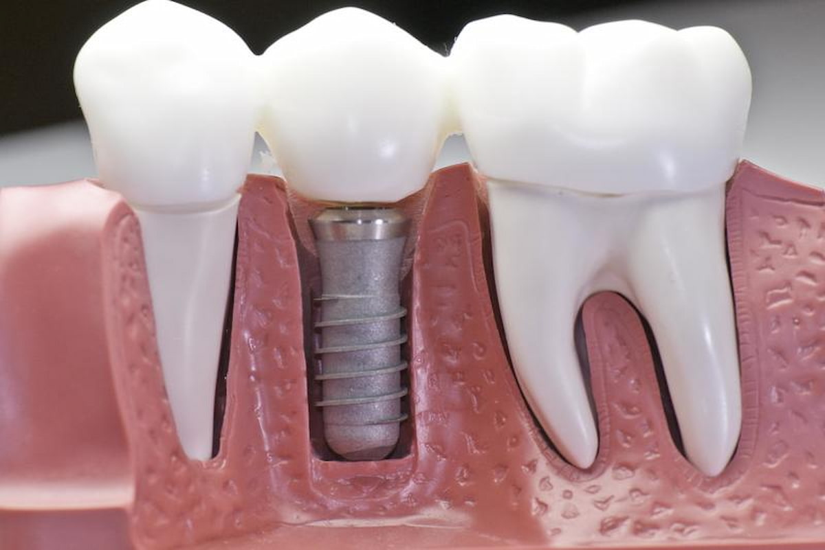 Nên làm cầu răng sứ hay cấy ghép Implant khi mất răng?