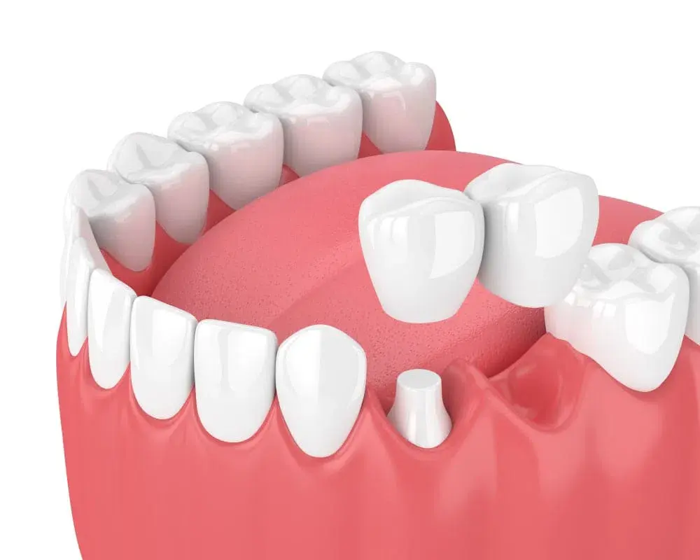 Làm cầu răng sứ có bền không? Sử dụng được bao lâu?