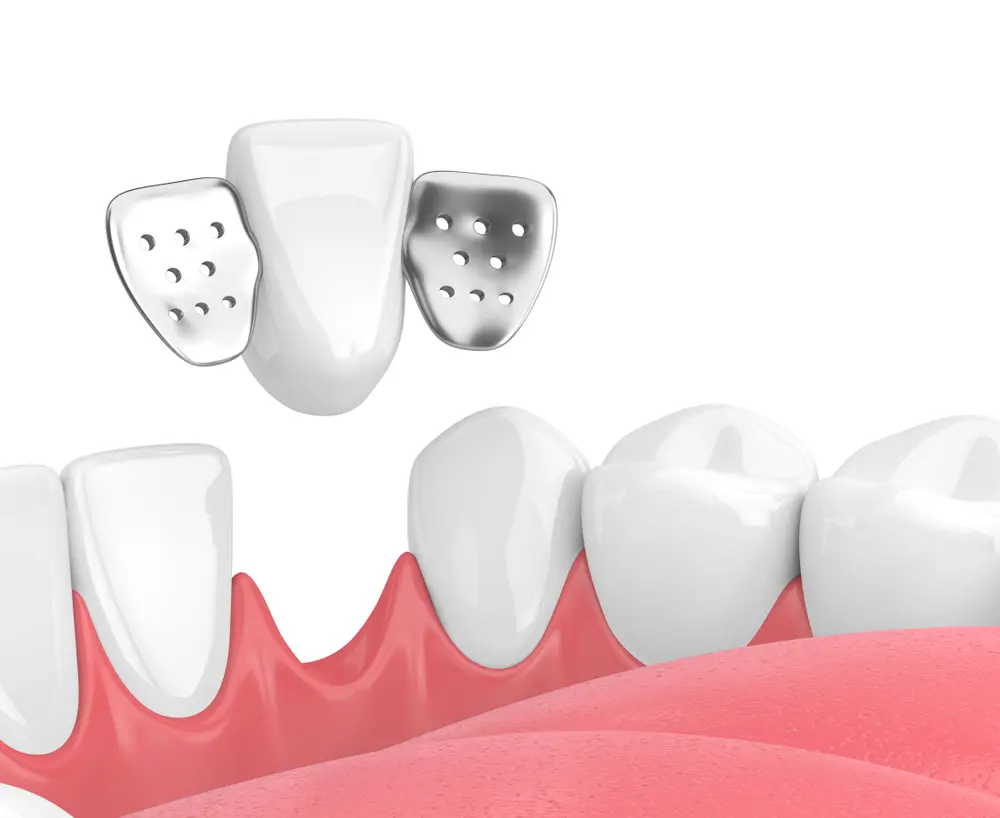 Veneers porcelain dental bridge