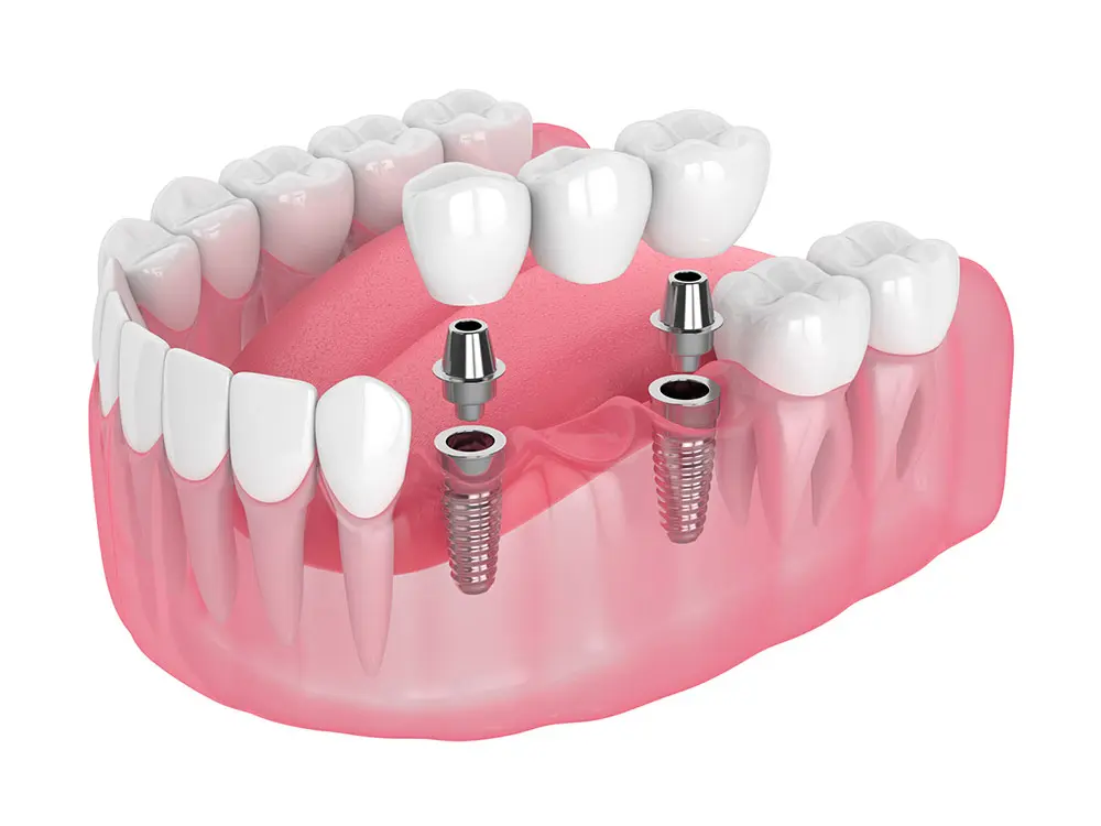 Porcelain dental bridge with implant support