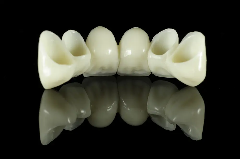 Porcelain dental bridges are highly aesthetic