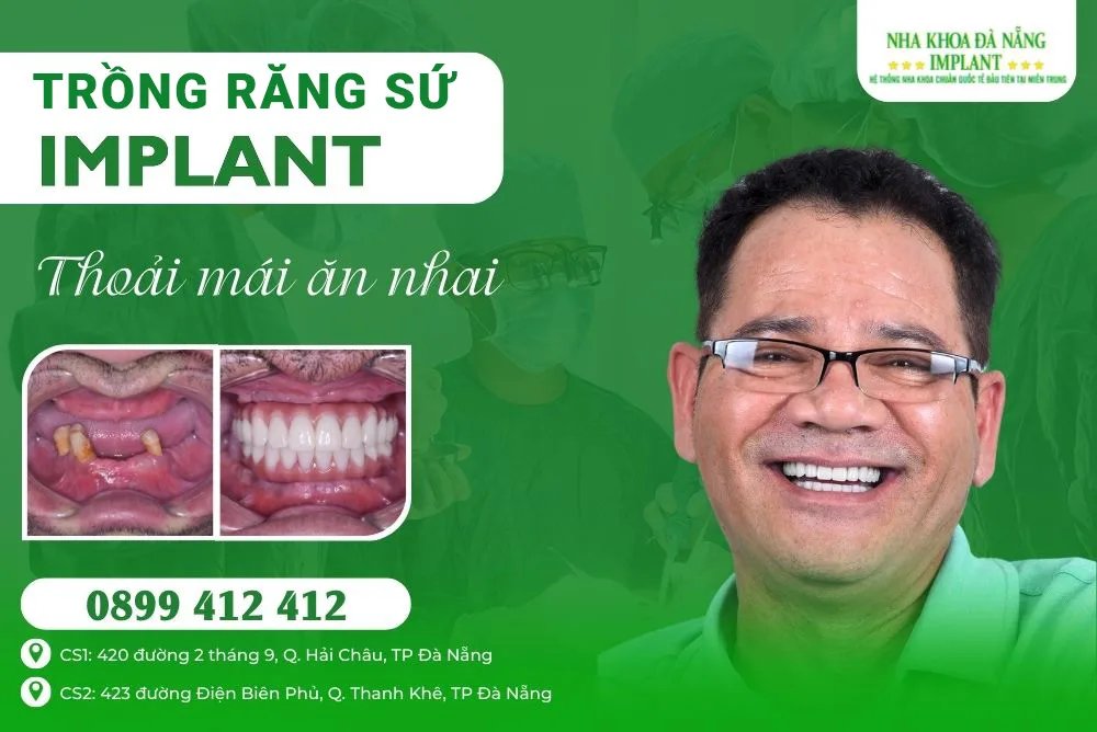 Trồng răng sứ implant đẹp giá rẻ ở nha khoa nào tại Đà Nẵng?