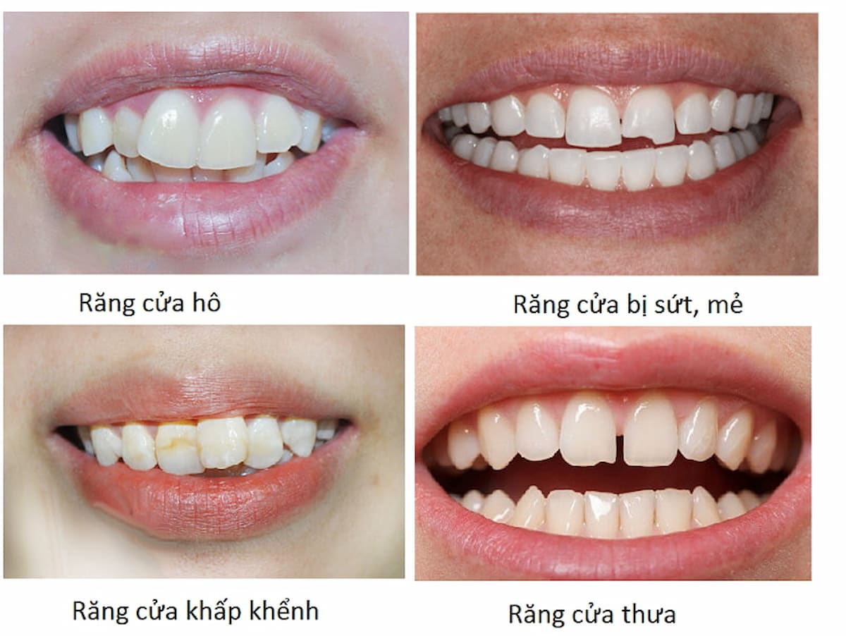 Trồng răng sứ giúp khắc phục các tình trạng như: răng móm, lệch lạc, răng thưa, sứt mẻ, xỉn màu, ố vàng,…
