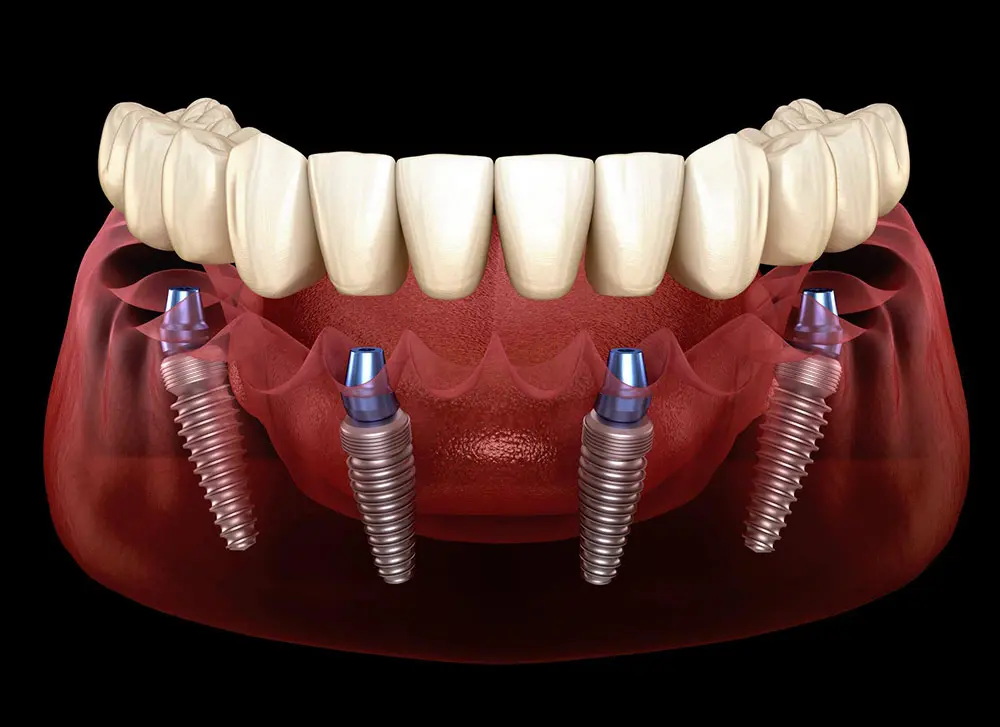 Trồng răng toàn hàm All on là gì? Chi phí điều trị đắt không?