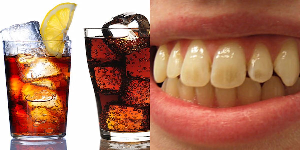 Không nước ngọt, các loại nước có ga,… nhằm gây tổn hại trực tiếp đến men răng khi niềng răng