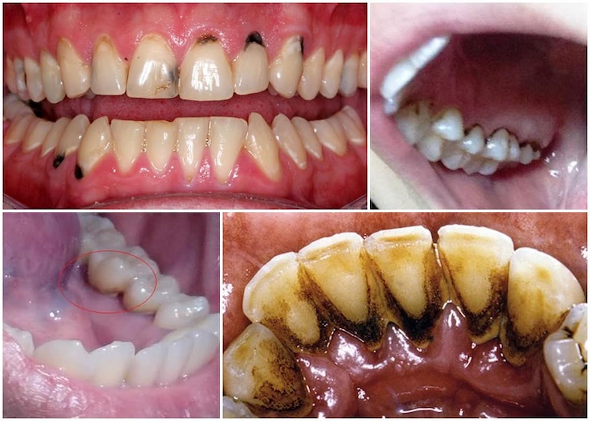 Người thường xuyên sử dụng chất kích thích cần lấy cao răng thường xuyên hơn