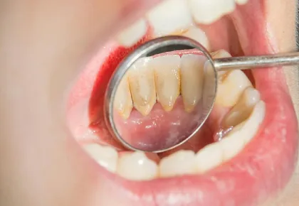 Bỏ túi 5 cách lấy cao răng tại nhà đơn giản và hiệu quả