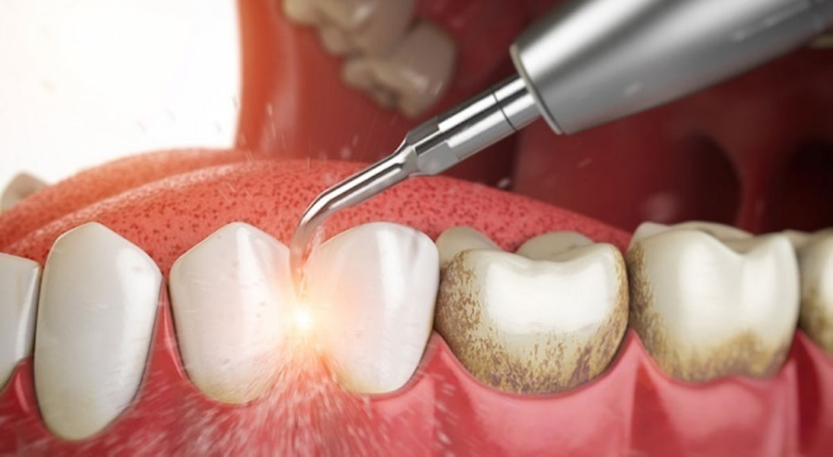 Nếu cao răng ở những vị trí có thể nhìn thấy thì lấy cao nhanh chóng và không đau đớn