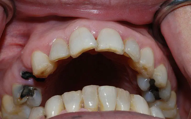 Không lấy cao răng gây nên tình trạng sâu răng