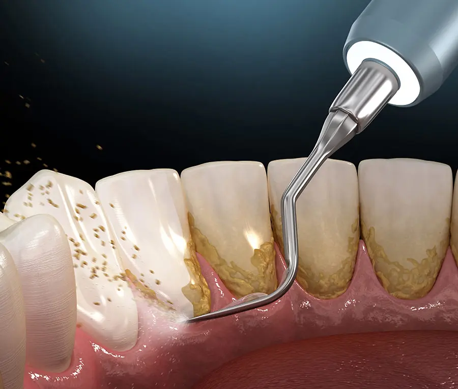 Lấy cao răng không đau bằng sóng siêu âm