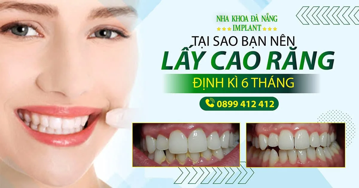 Lấy cao răng có đau không? Địa chỉ cạo vôi răng uy tín nhất