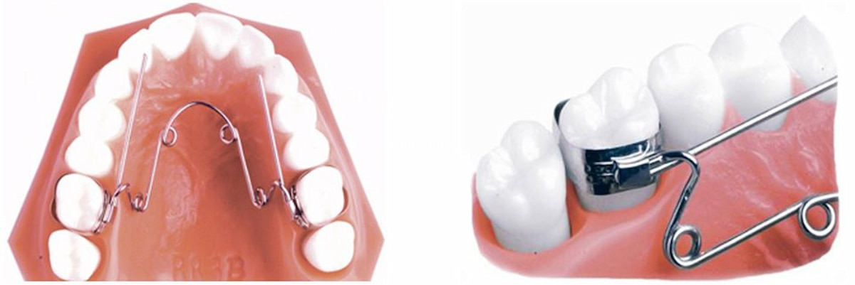 Có thể áp dụng nhiều phương pháp để tạo ra một khoảng trống cho răng dịch chuyển về đúng vị trí