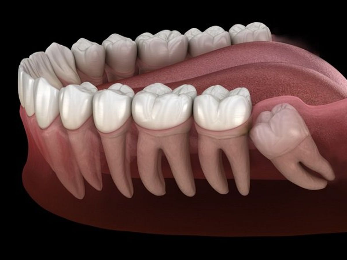 Nên nhổ răng khôn mọc lệch dù chưa gây đau đớn để tránh việc răng khôn mọc lệch làm: gây nhiễm trùng, khít hàm, sưng, đau nhức...