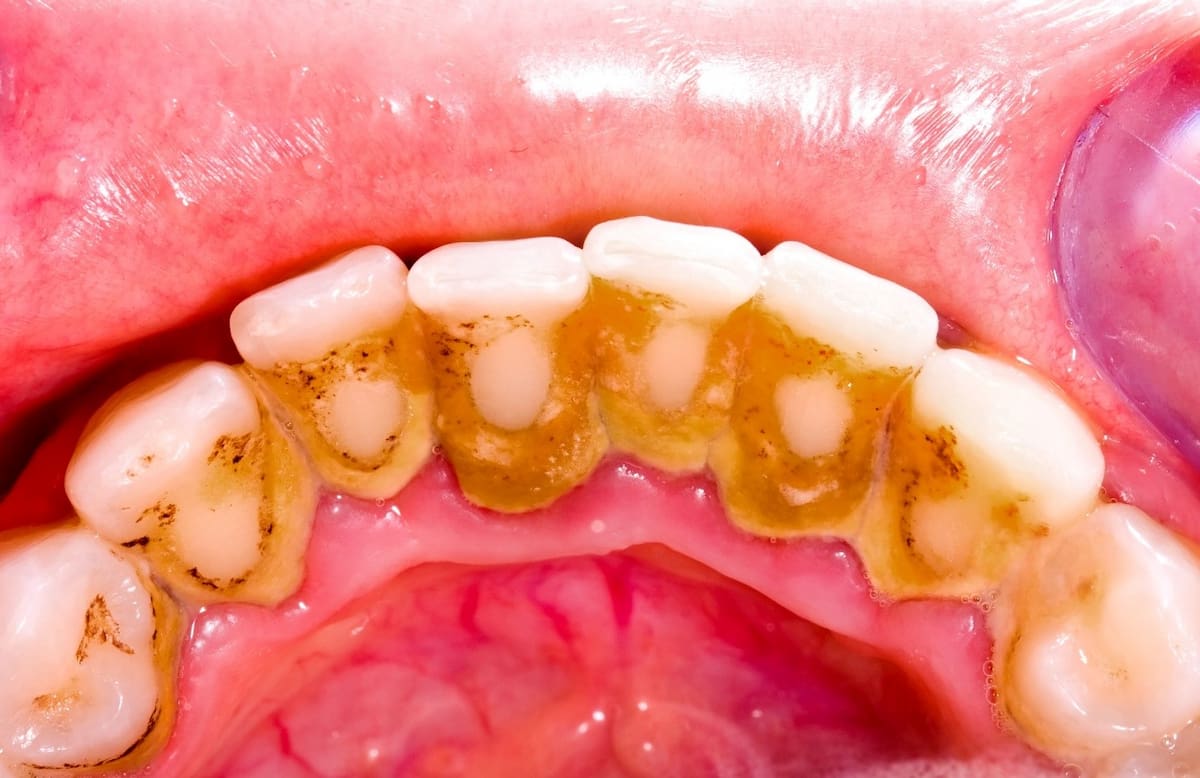 Dụng cụ, máy móc tại Nha khoa Đà Nẵng Implant đều được vô trùng trước khi thực hiện lấy cao răng