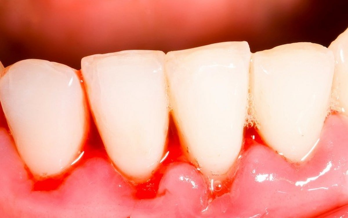 Cao răng để lâu có thể dẫn đến biểu hiện chảy máu khi đánh răng, hôi miệng