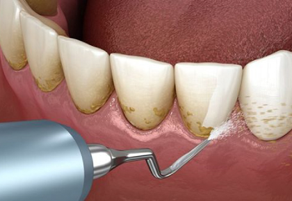 Cao răng là gì? Tại sao phải lấy cao răng thường xuyên?