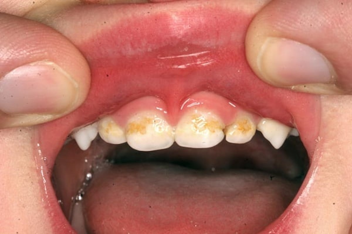 Lấy cao răng có làm trắng răng không?