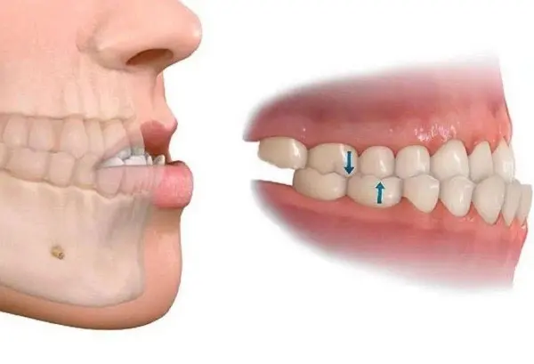 Răng móm là tình trạng sai khớp cắn và sai lệch tương quan giữa hai hàm