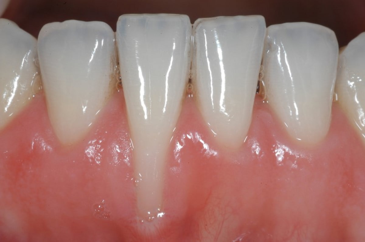 Nướu tiếp xúc nhiều với các mảng bám cao răng lâu ngày là nguyên nhân gây tụt lợi