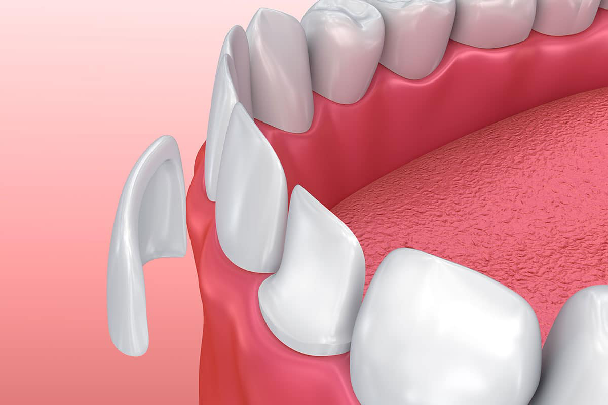 Tất tần tật những điều bạn cần biết về bọc răng sứ veneer