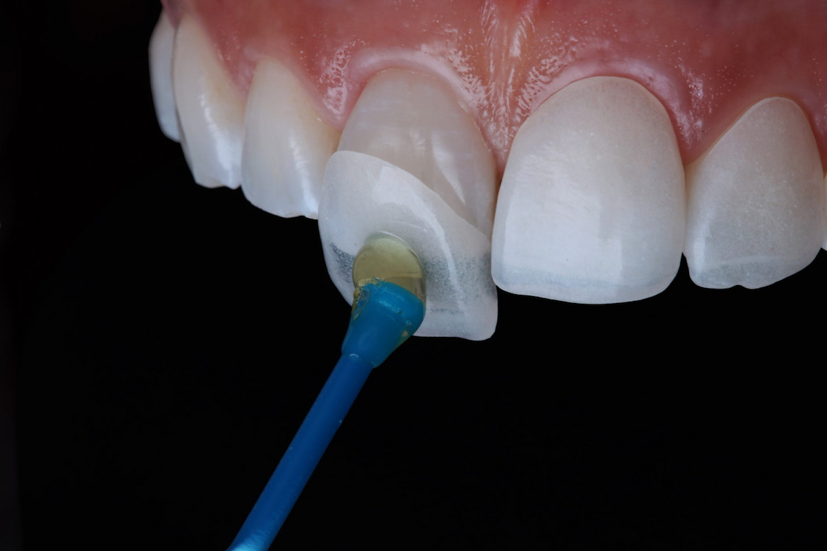 Dán răng sứ veneer có bền không? Có làm hỏng men răng không?