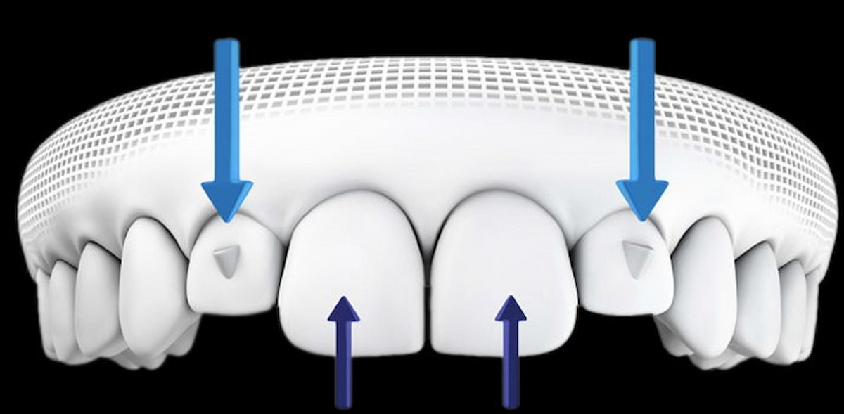 SmartForce đảm bảo tạo ra lực tác động chính xác đến từng chiếc răng