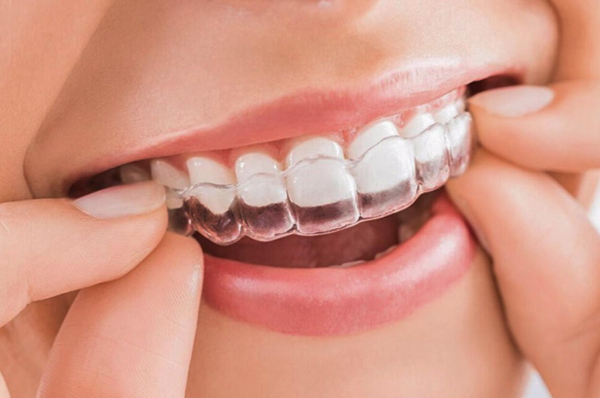 Niềng răng Invisalign phù hợp với hầu hết các trường hợp như sai lệch về răng, khớp cắn